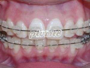 Dental A22 Orthodontics Roth Ceramic Bracket Braces 5 5  